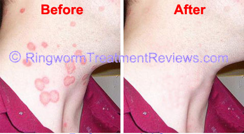 Ringworm Treatment Results with Phytozine
