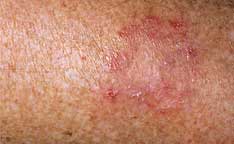 Does Bleach Kill Ringworm On Skin